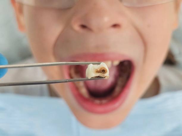 Best Emergency Dentist for Lost Fillings or Crowns in Ambridge, PA